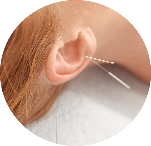 Øre akupunktur